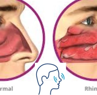 Dr. Hassan Al Warraqi's Approach to Disease Treatments Rhinitis (Inflammation of the Nasal Mucous Me