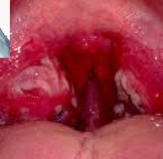 Dr. Hassan Al Warraqi's Approach to Disease Treatments Pharyngitis (Sore Throat)