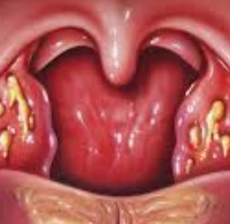 Tonsillitis