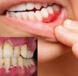 Gingivitis