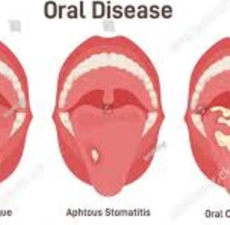 stomatitis