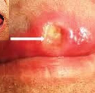 Painful Dyspeptic Ulcer