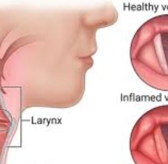 Laryngitis