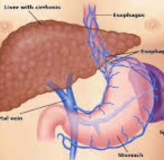 Esophageal Varices