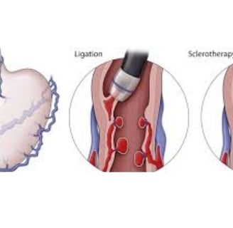 esophageal varices endoscopic procedure