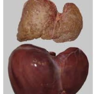 liver cirrhosis