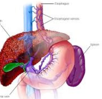 Esophageal Varices: A Comprehensive Guide to Managements