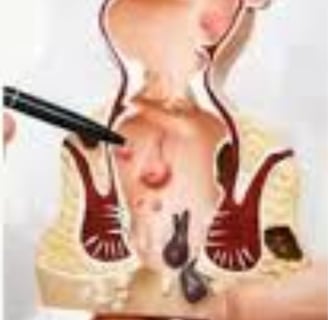 FAQs : Natural Remedies for Anal Fissures and Fistulas: Start with Honey and Fasting