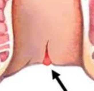 FAQs : Natural Remedies for Anal Fissures and Fistulas: Start with Honey and Fasting