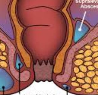 FAQs Natural Remedies for Anal Fissures and Fistulas Start with Honey and Fasting