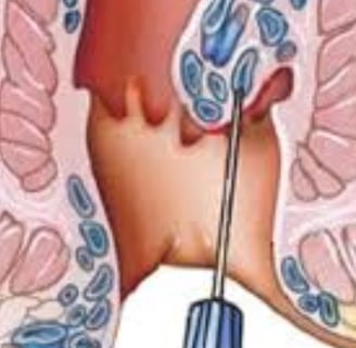 FAQs Natural Remedies for Anal Fissures and Fistulas Start with Honey and Fasting