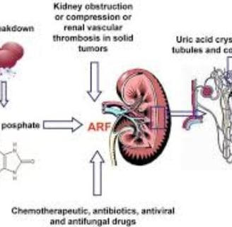 Fasting and Tumor Lysis Syndrome