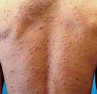 Fasting For Skin Allergies Itching & Pruritus