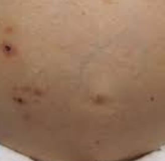 Fasting for Skin Allergies, Itching, and Pruritus