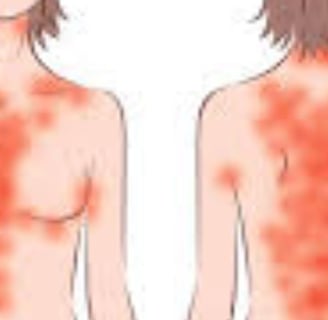 Fasting For Skin Allergies Itching & Pruritus