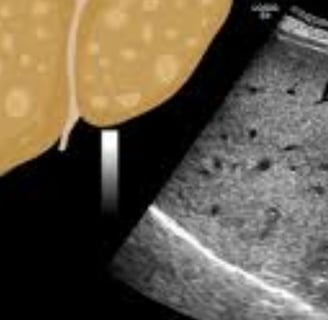 fatty liver ultrasonography