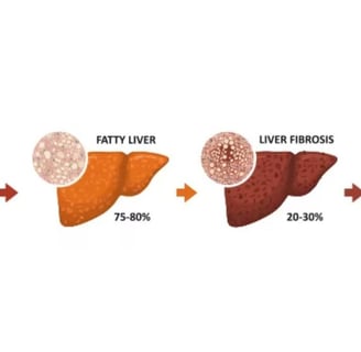 stages of fatty liver