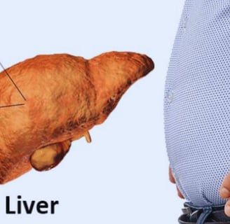 fatty liver & the only hope for the patients