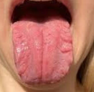 FISSURED TONGUE