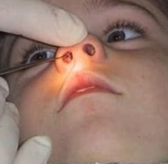 nasal f b removal 