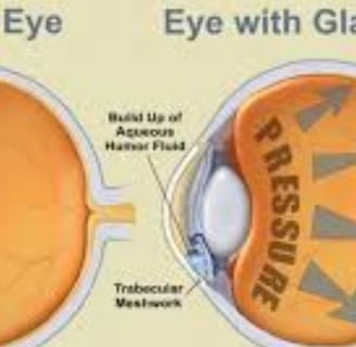 Glaucoma : Treatment alternative