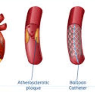 angioplasty