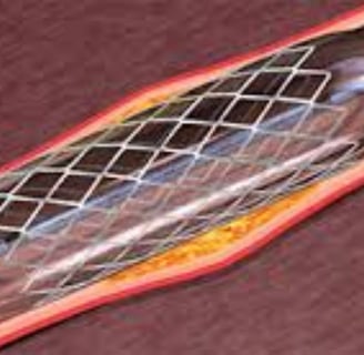stent placement