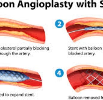 ballon angioplasty with stent