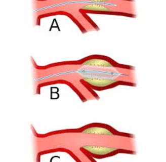 angioplasty