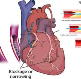 Cardiac Catheterization: Why Every Case Is Followed by a Stent