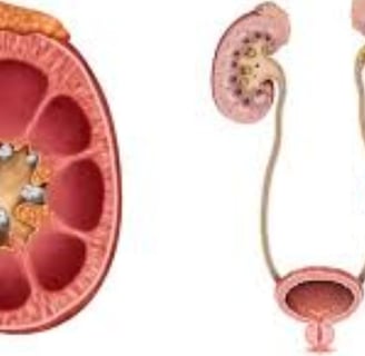 Causes and Prevention of Kidney Stones, Impacted