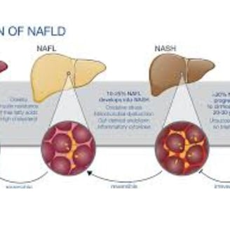 progression of liver fatty