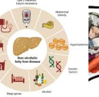 genetic causes of fatty liver disease