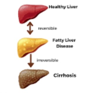 stages of fatty liver diseases