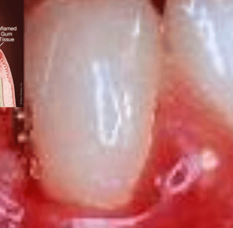 gums disease