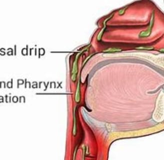 a diagram of the anatomy of the throat of the head and neck oost nasal discharge