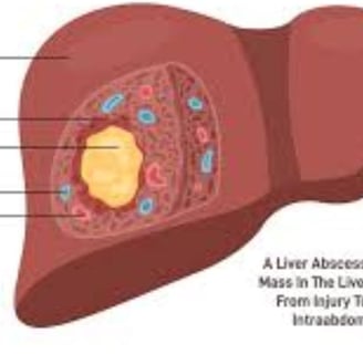 Multiple Body Abscesses Fasting and Honey (4)