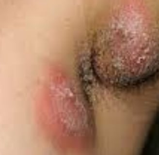Multiple Body Abscesses