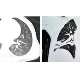 Multiple Body Abscesses Fasting and Honey (6)