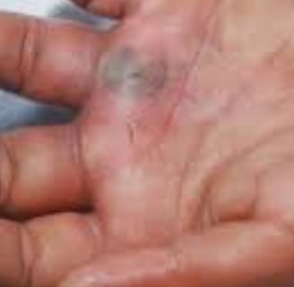 Multiple Body Abscesses