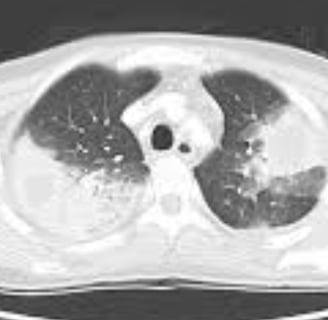 Multiple Body Abscesses Fasting and Honey (8)