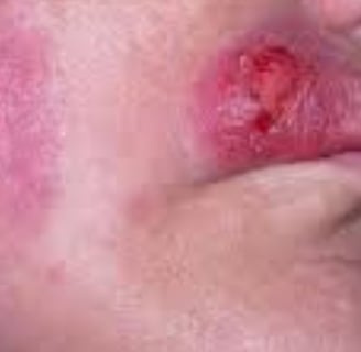 Multiple Body Abscesses Fasting and Honey