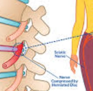 a diagram of a spinal disc  