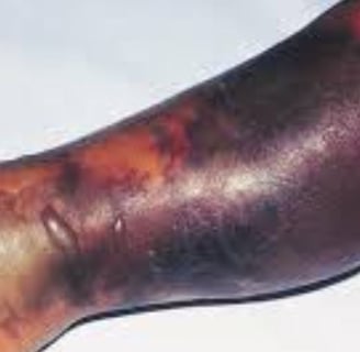 Necrotizing fasciitis Flesh-eating Fournier’s gangrene & novel treatment