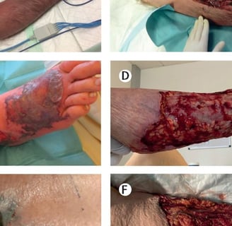 treatment lasts for several weeks