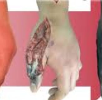 Necrotizing fasciitis Flesh-eating