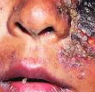 Necrotizing fasciitis Flesh-eating ocular disease