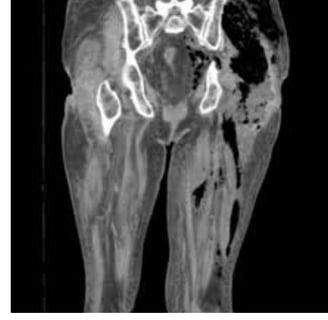 Necrotizing Fasciitis Flesh-Eating disease