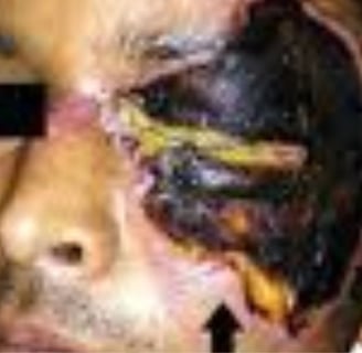 Necrotizing fasciitis Flesh-eating ocular disease