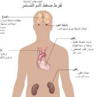 اضراره الضغط المستمر
